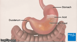 ulcer